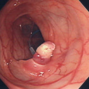 胃２型進行癌